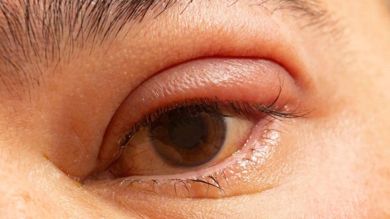 Get Rid Of Eyelid Inflammation By Following The Points!!